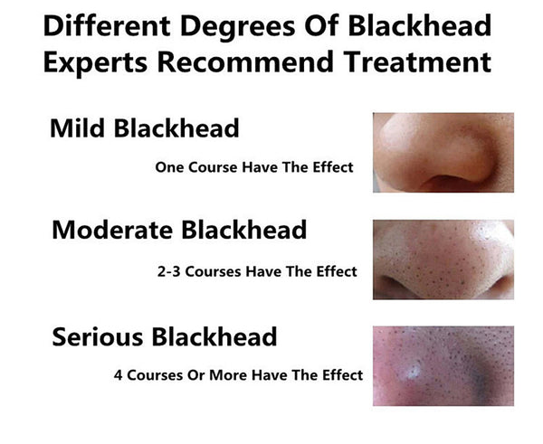 Black Head Remover (Free Shipping)